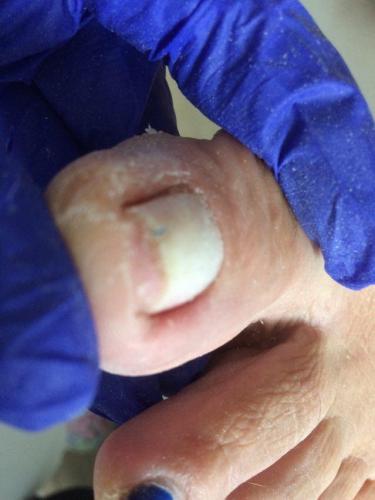 Wrastające paznokcie,, leczenie wrastających paznokci, podolog Szczecin, Anna Gralińska, gabinet podologiczny, centrum zdrowej stopy