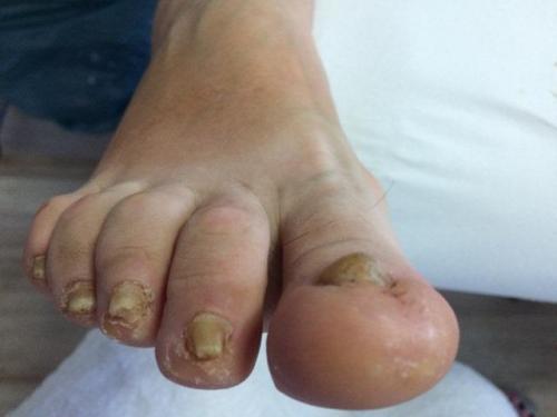 Wrastające paznokcie,, leczenie wrastających paznokci, podolog Szczecin, Anna Gralińska, gabinet podologiczny, centrum zdrowej stopy